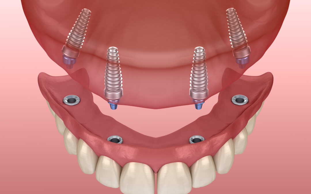 All-on-4 Dental Implants: A Guide to a Lasting Smile